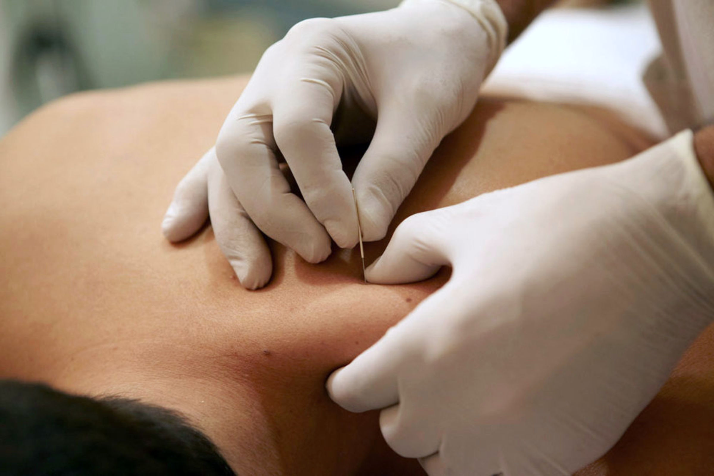 traitement dry needling, physiothérapie